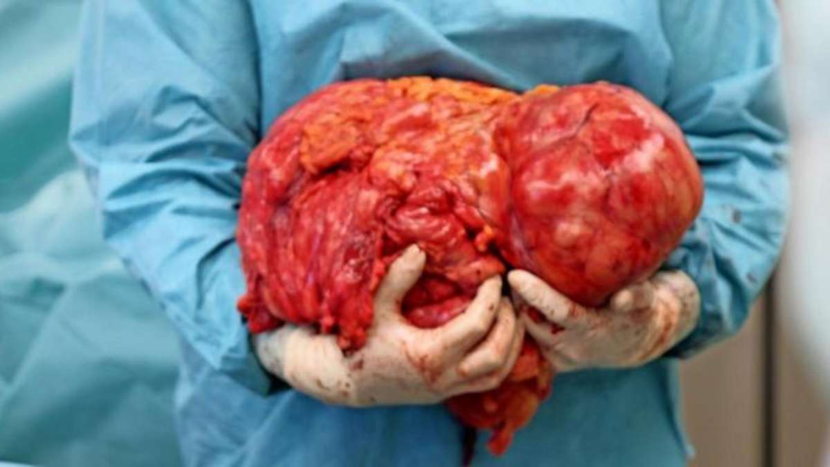 Thüringen: Chirurgen befreien Frau von 15 Kilo schwerem Tumor