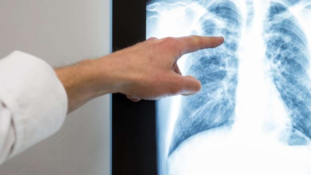 Nordhausen/Erfurt: Zwei Menschen sterben an Tuberkulose